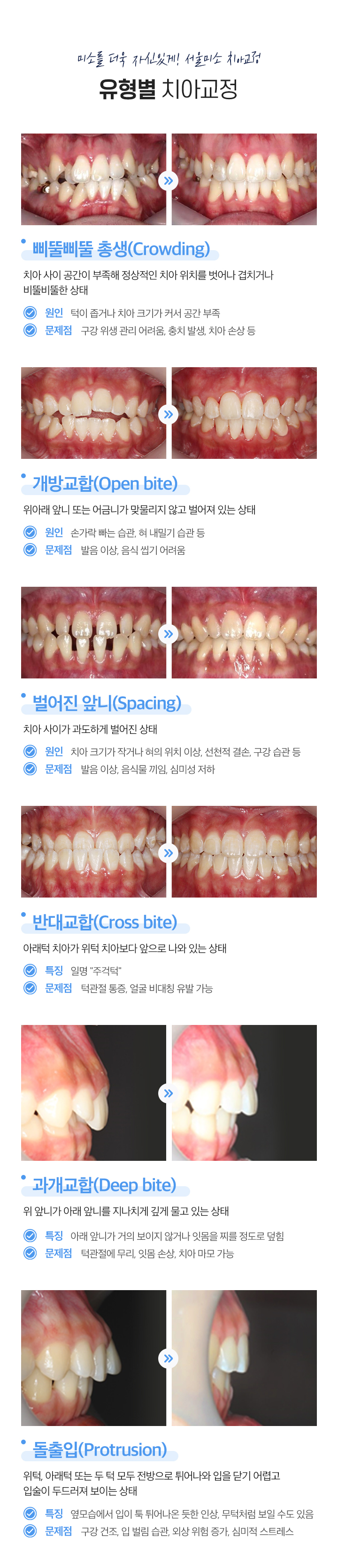유형별 치아교정