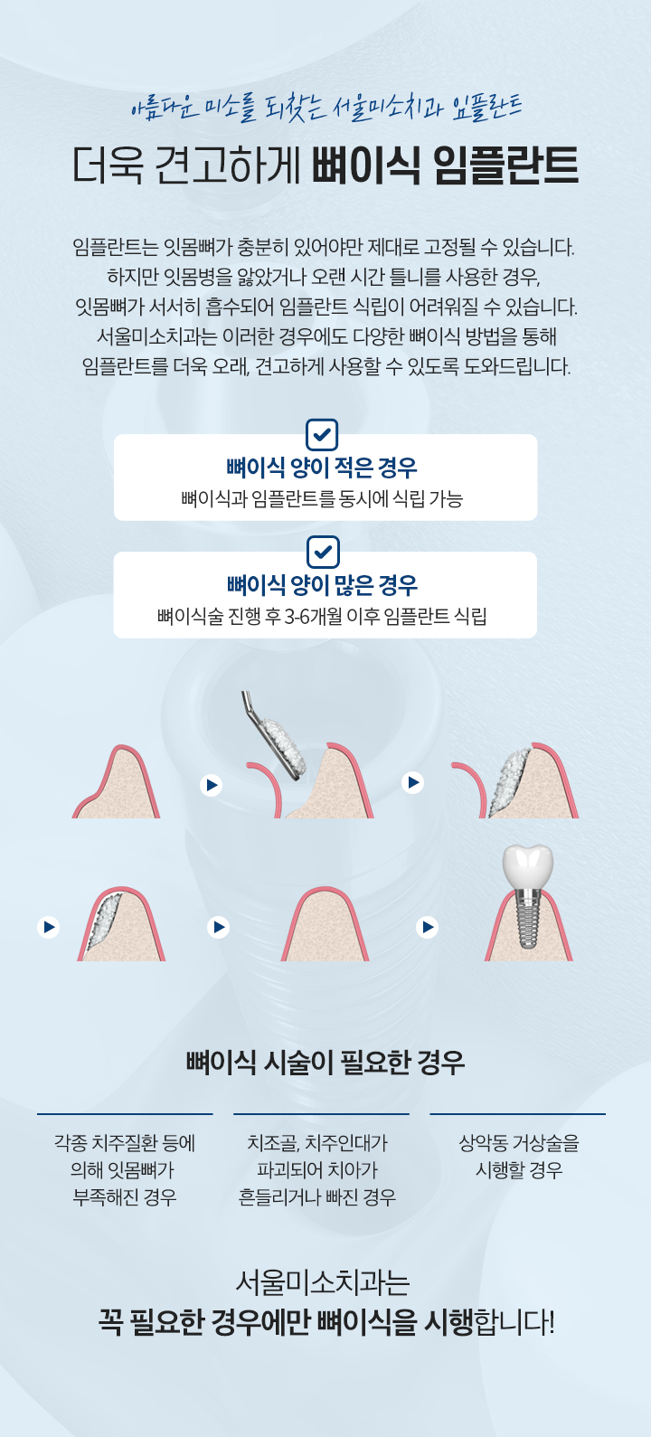 더욱 견고하게 뼈이식 임플란트