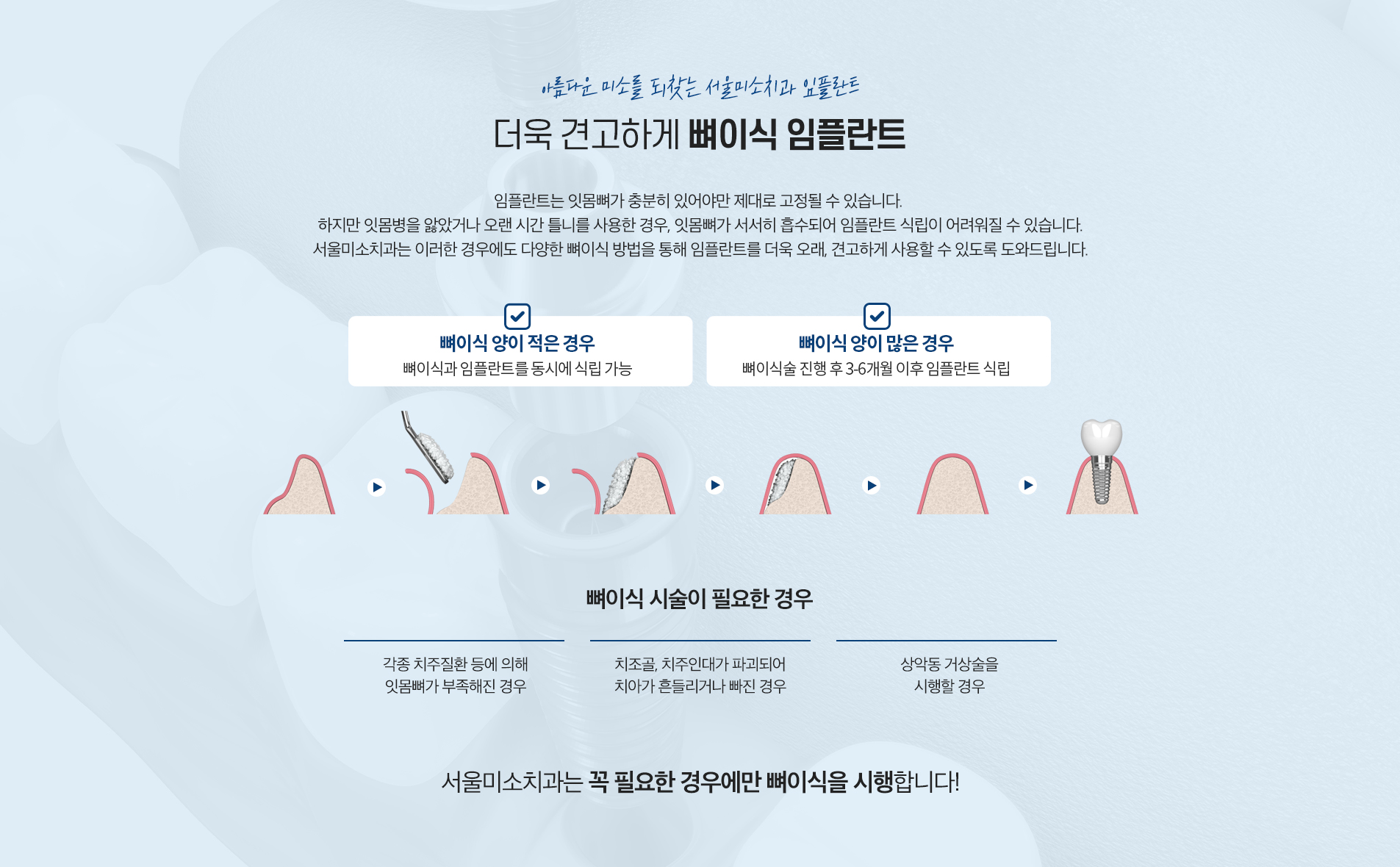 뼈이식 임플란트