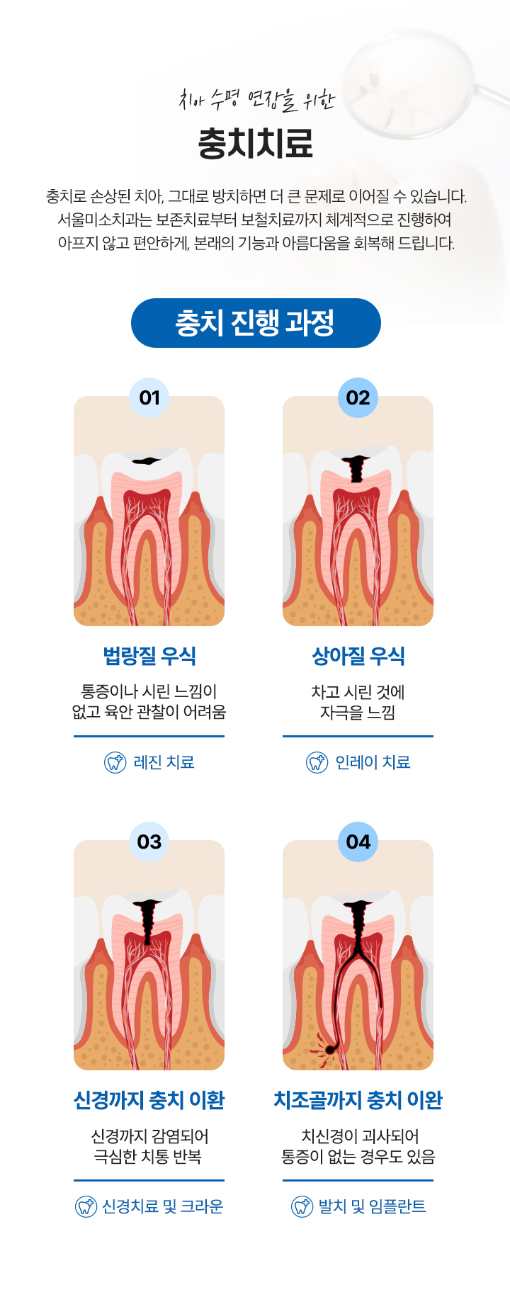 충치치료