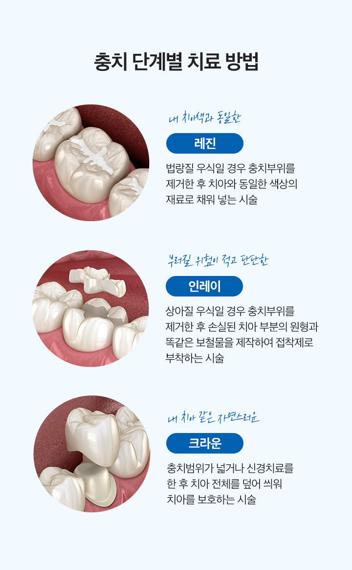 충치 단계별 치료 방법
