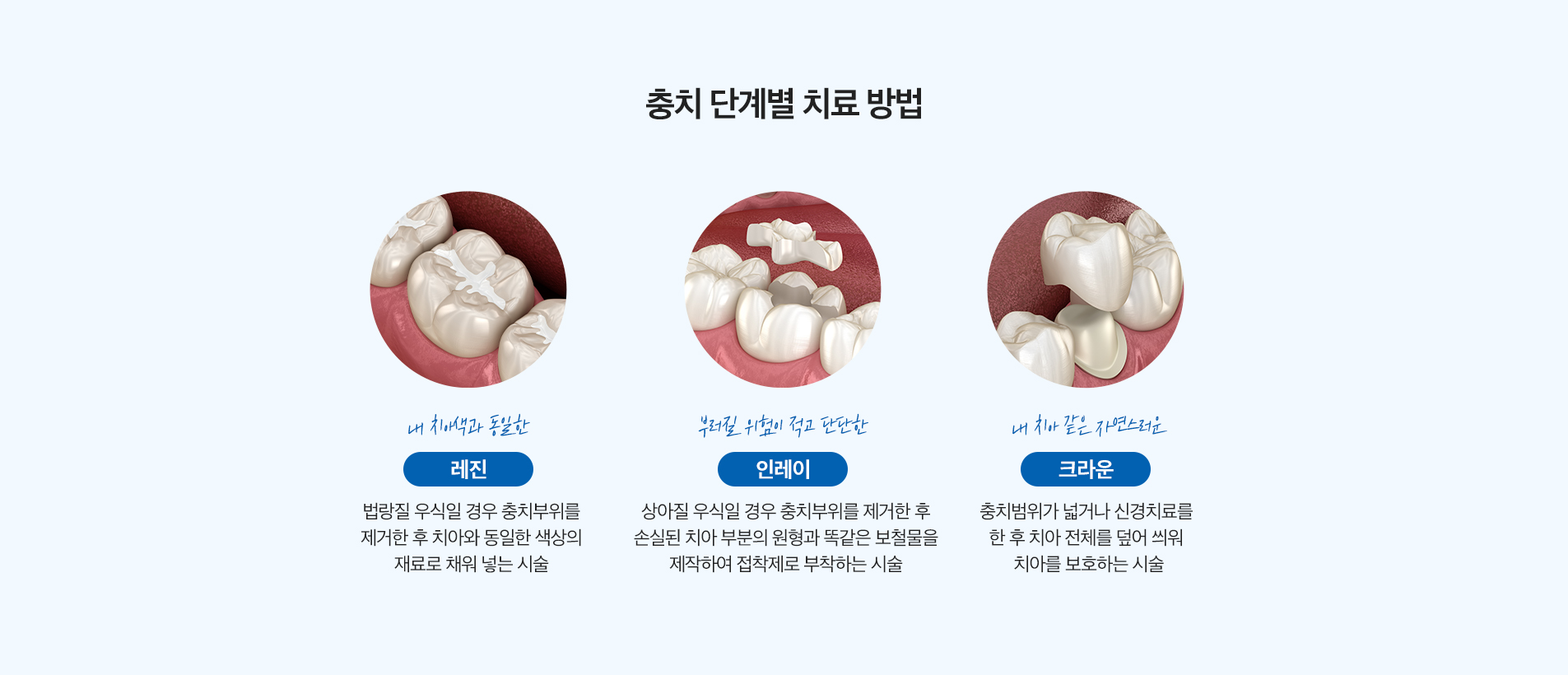 충치 단계별 치료 방법
