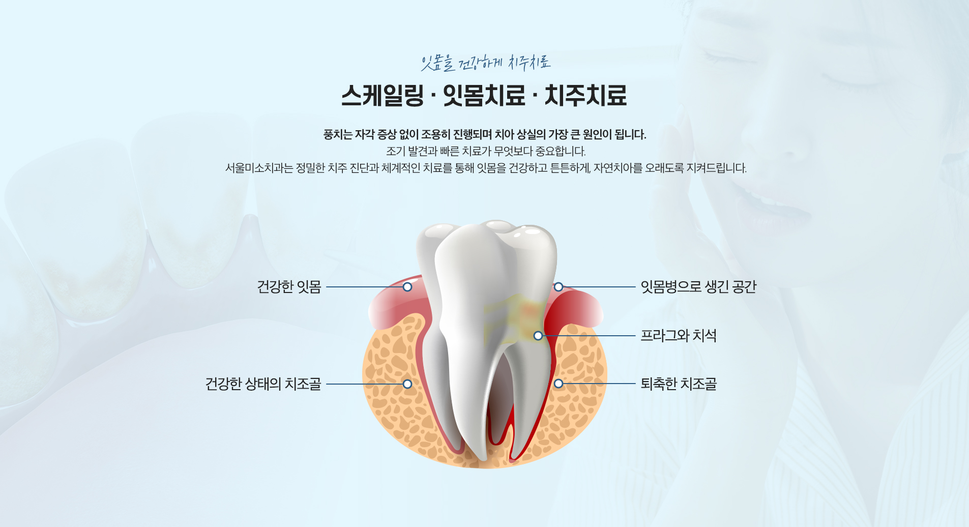 스케일링/잇몸치료/치주치료